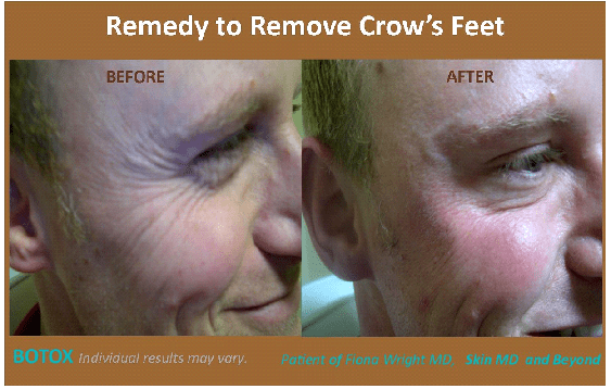 Wrinkle Treatment Frisco TX
