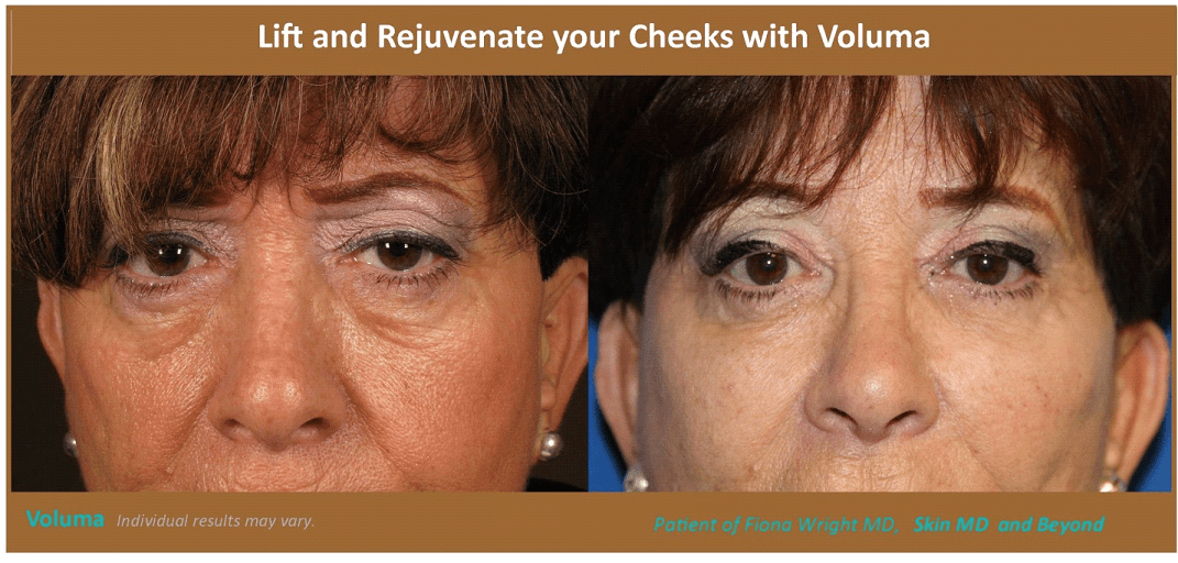 Before & After image of Cellulite Removal Plano TX