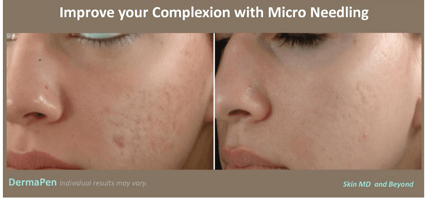 Before & After Image of Microneedling Frisco TX