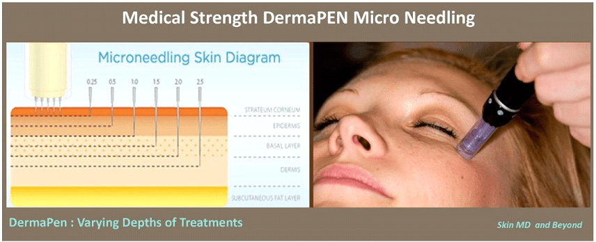 Microneedling Frisco TX