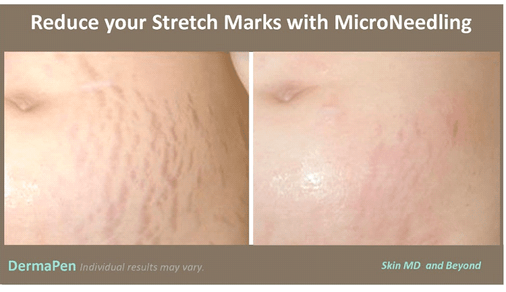 Before & After Image of DermaPen Treatment Plano TX