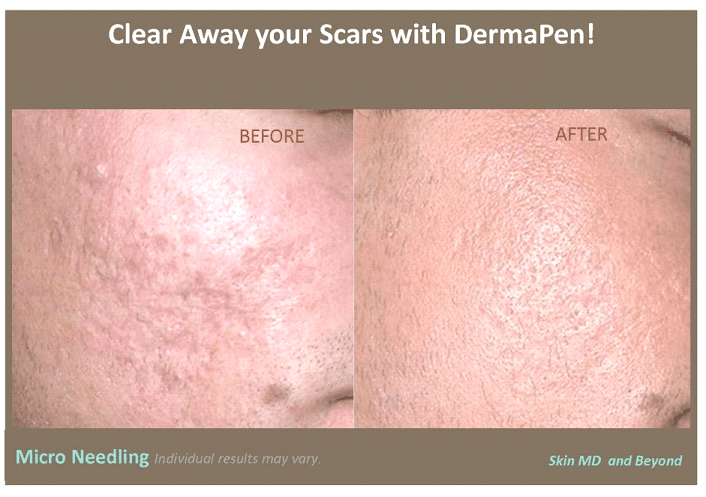 Before & After Image of DermaPen Treatment Frisco TX