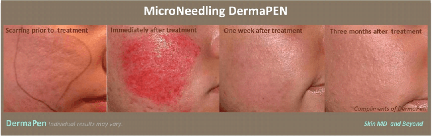 Before & After Image of Microneedling Treatment Frisco TX