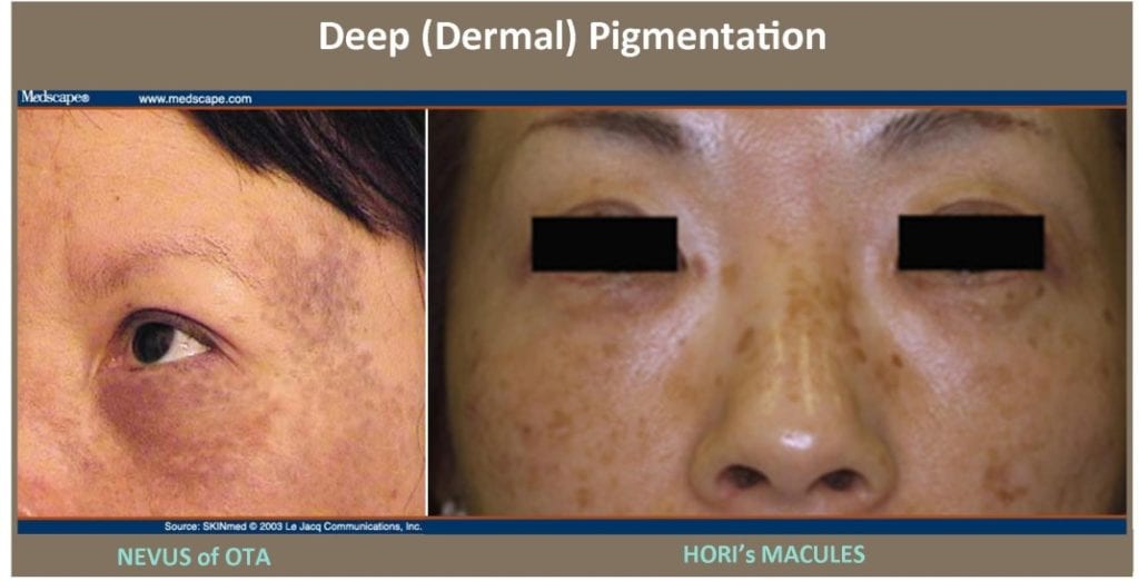 Deep(Dermal)Pigmentation