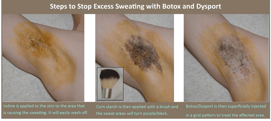 Hyperhidrosis Frisco TX