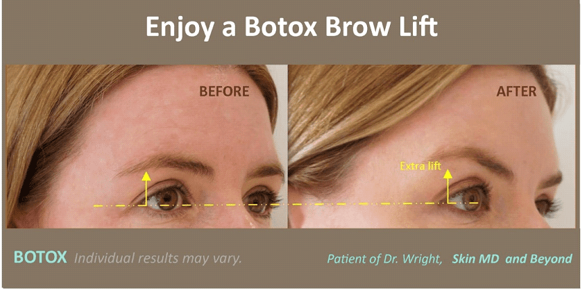 before and after photo of woman's brow after skin laxity treatment