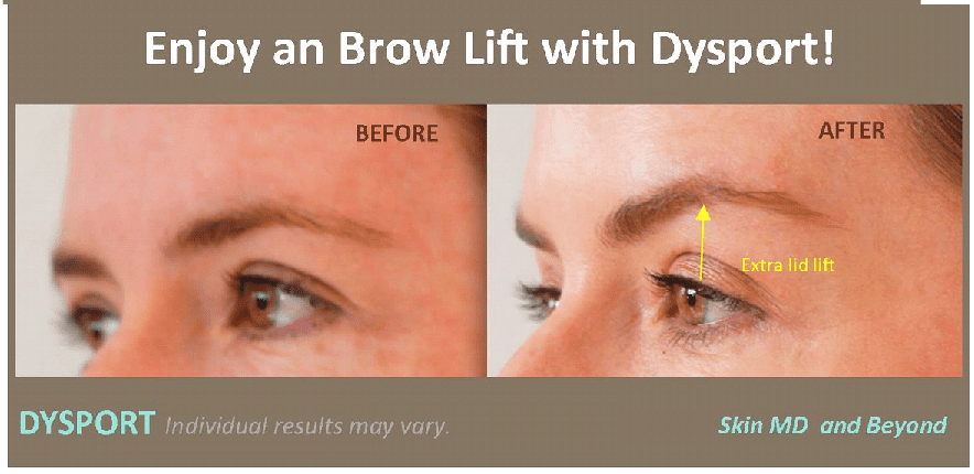 Before and after Brow Lift Treatment Frisco TX
