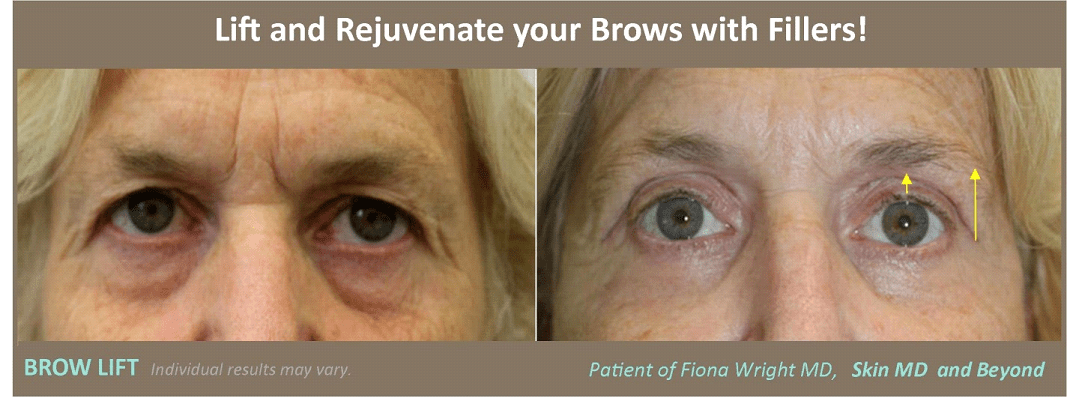 Before and after Eyebrow Droop Plano TX