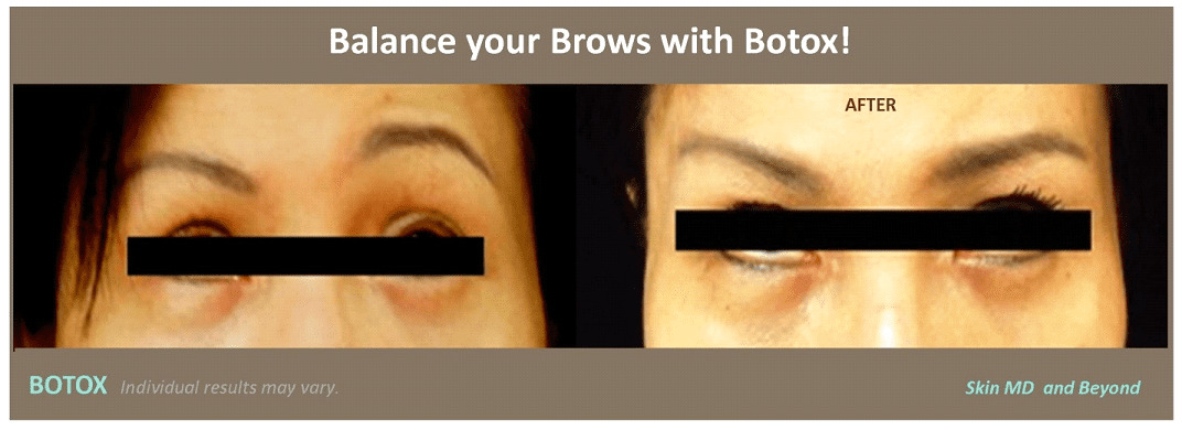 Brow Rejuvenation Plano TX