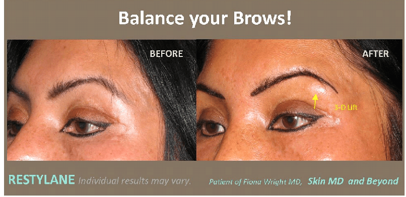 Brow Rejuvenation Frisco TX