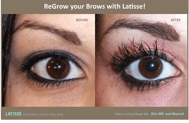 Before and after Brow Rejuvenation Frisco TX
