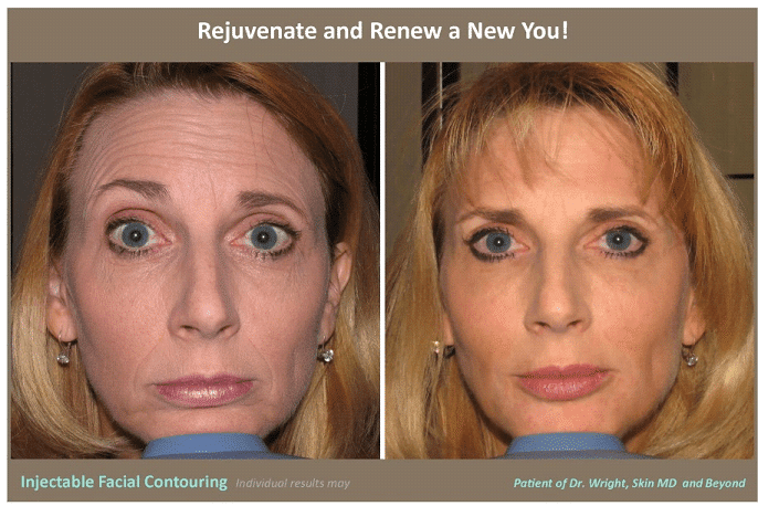 before and after photo of woman's face after skin laxity treatment