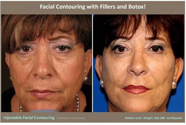 before and after photo of woman's face after skin laxity treatment
