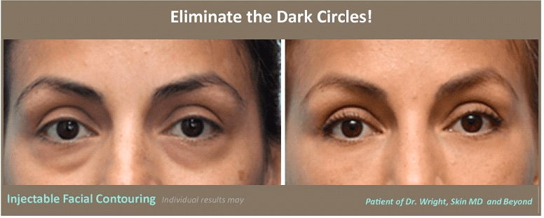 Before and after Eye Bag Treatment Plano