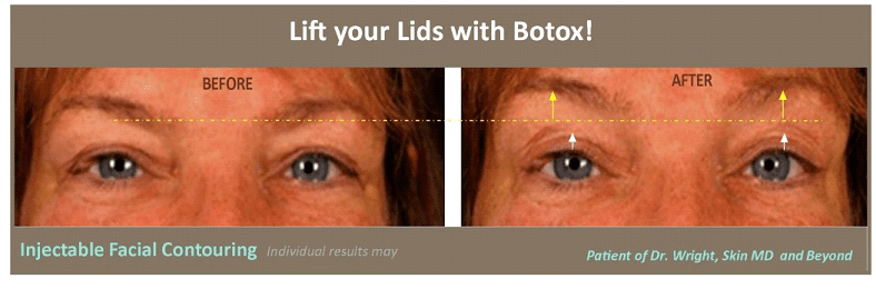 Before and after Facial Contouring Plano TX