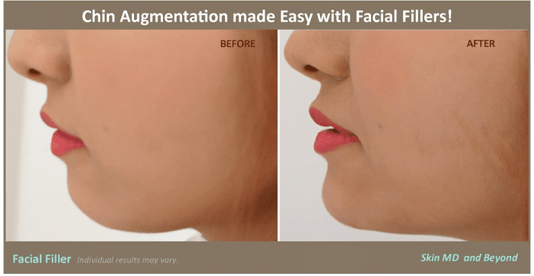 female patient’s chin before and after chin augmentation with dermal fillers, chin more pronounced after treatment