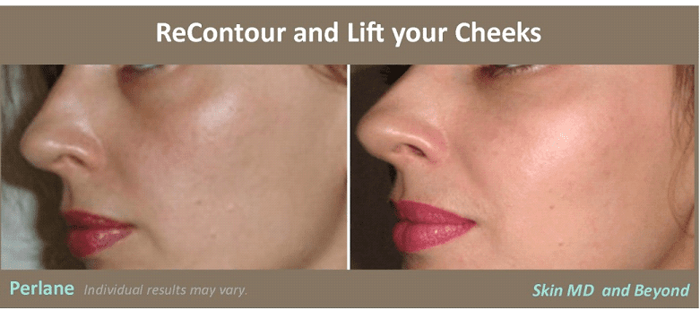 Before and after Facial Sculpting Plano TX