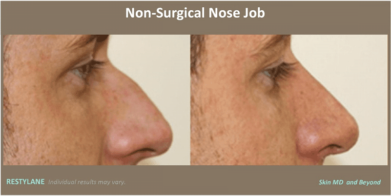 side profile of male patient's nose before and after non-surgical nose job, nose bump gone after procedure
