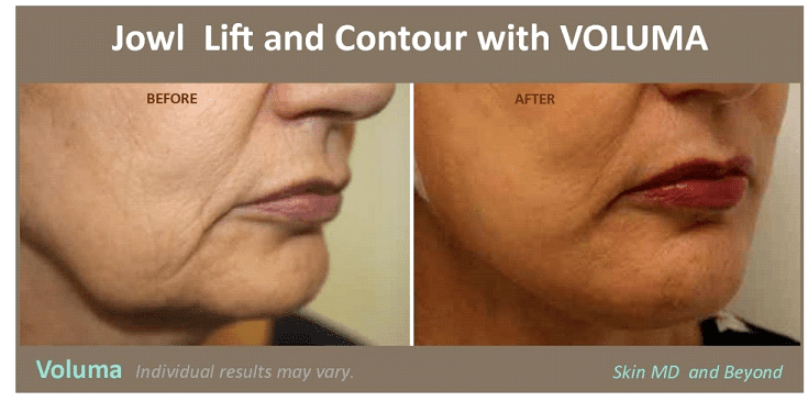 before and after photo of woman's mouth after skin laxity treatment