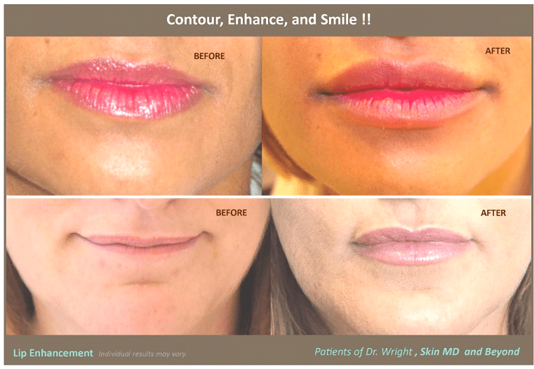 Before and after dermal fillers Frisco TX