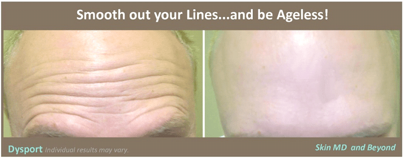 Before & After Dysport Plano TX