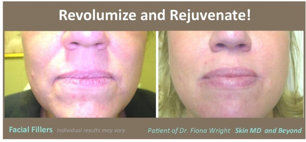 facial-fillers-revolumize-and-rejuvenate