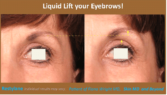  Before & After Eyebrows Frisco TX