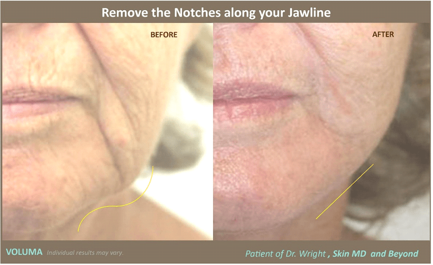 Before & After image of Jawline Rejuvenation Frisco TX