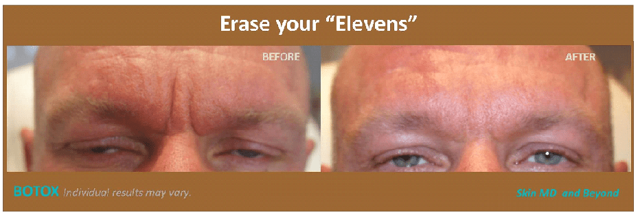 Before & After Frown Lines Plano TX
