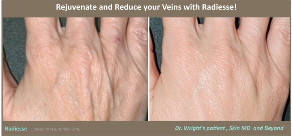 hand-rejuveation-reduce-veins