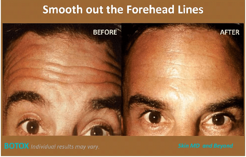 Before & After Forehead Lines Plano TX