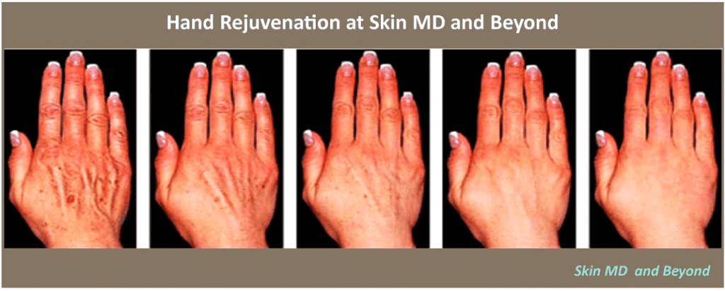  hand rejuvenation progress, veins and spots invisible at end of treatment