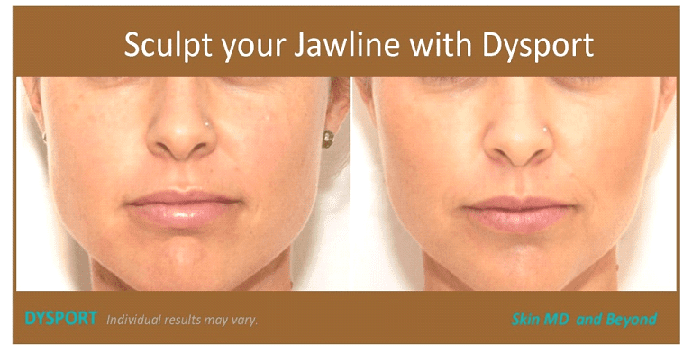 Jaw Botox for Teeth Grinding: Costs, Risks & Insurance Facts