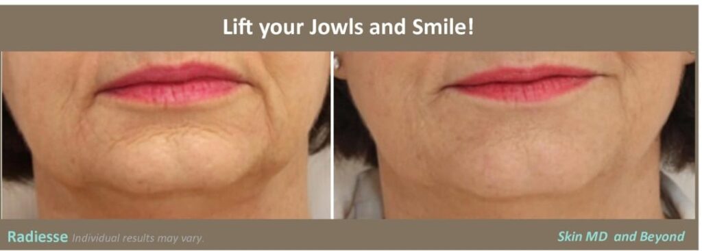 jowl-lift-contour