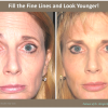 JUVEDERM