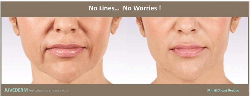 JUVEDERM