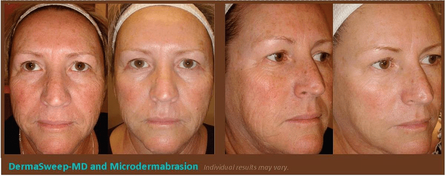 Before & After image of Sun Damaged Treatment Skin Plano TX