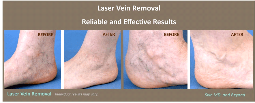 laser vein removal in foot before and after 