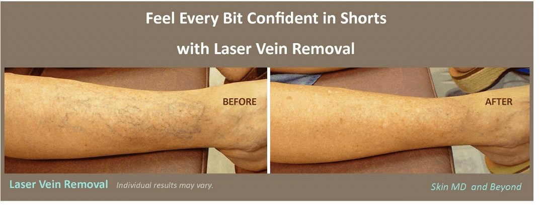 Laser Vein removal before and after treatment