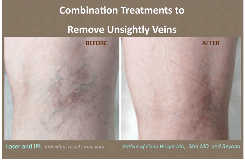 Laser and IPL Treatment removing unsightly veins Before and After