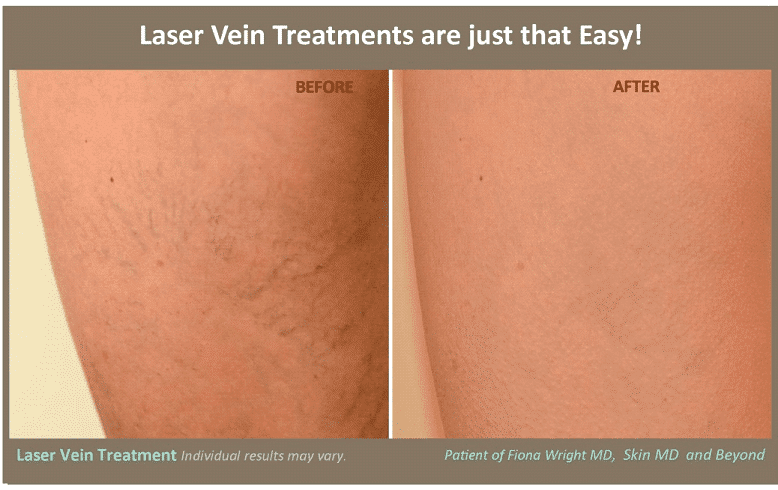 Before & After Image of Spider Vein Treatment Frisco TX