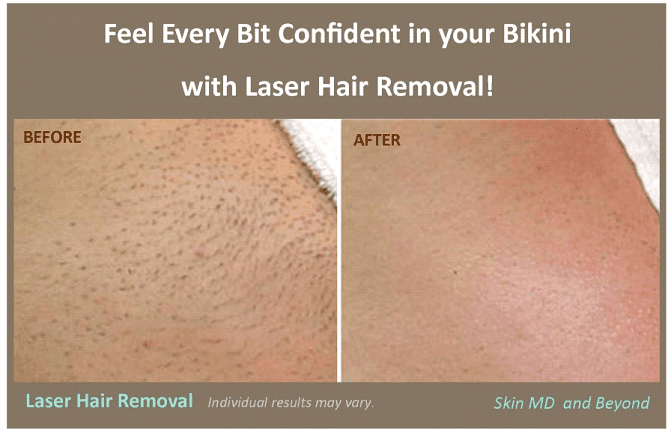 Bikini Area Hair Removal