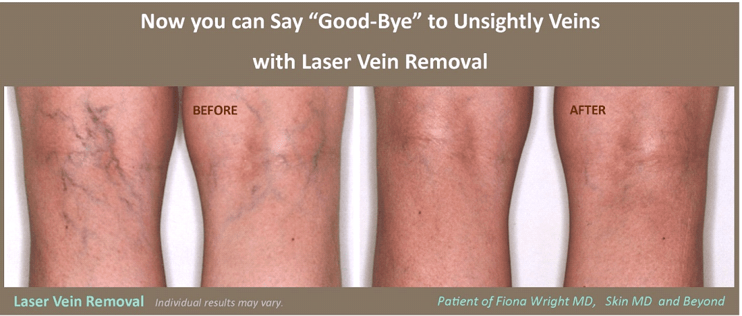 Laser vein removal before and after on back of knee