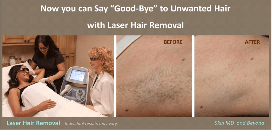 Laser Hair Removal Before and After Plano TX