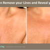 Laser Resurfacing ResurFX