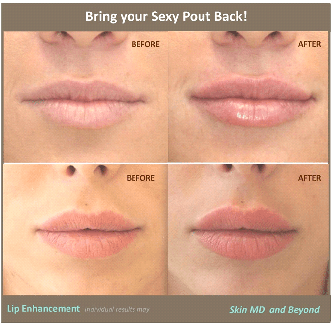 Before & After image of Lip Injection Frisco TX
