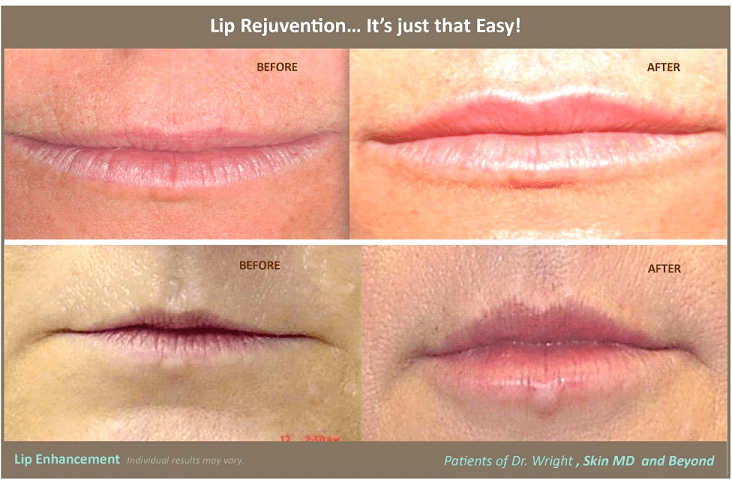 Before & After image of Thin Lips Treatment Plano TX