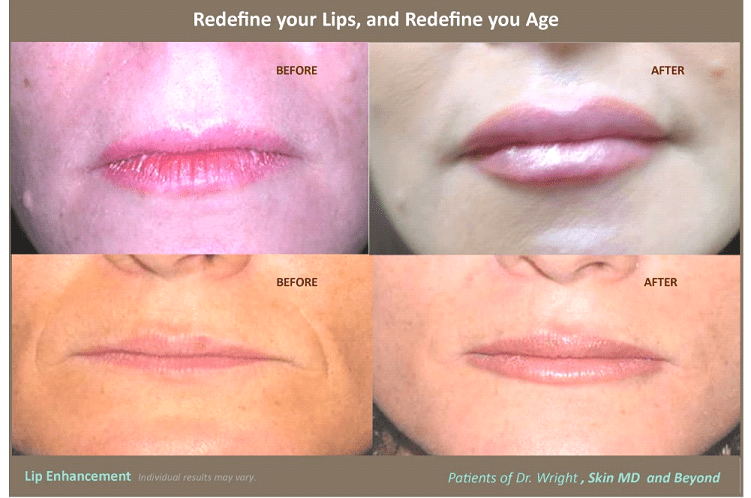Before & After image of Flat Lips Treatment Frisco TX