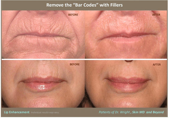 Before & After Lip Enhancement Frisco TX