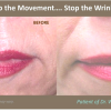 Lip Enhancement